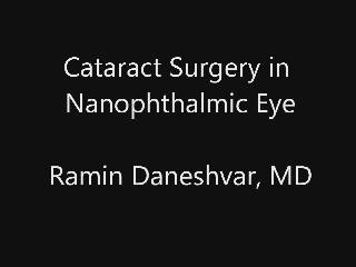 Cataract Surgery in Nanophthalmic Eye
