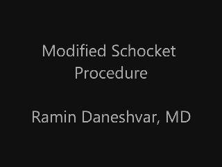 Modified Schocket Procedure