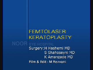 Femto Keratoplasty