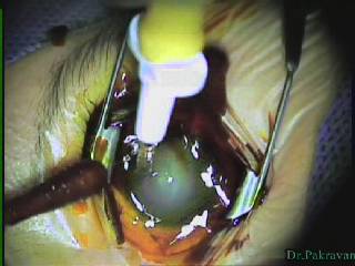 Trabeculotomy + Modified Trabeculectomy