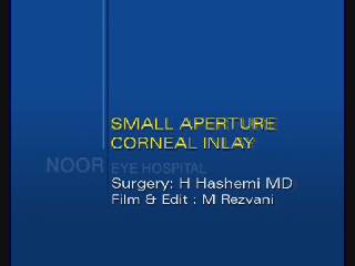 Small Aperture Corneal Inlay