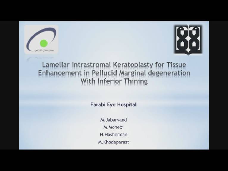 نفر سوم جشنواره - Lamellar Intrasromal Keratoplasty 